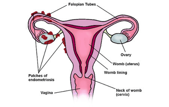 Endometriosis diagram