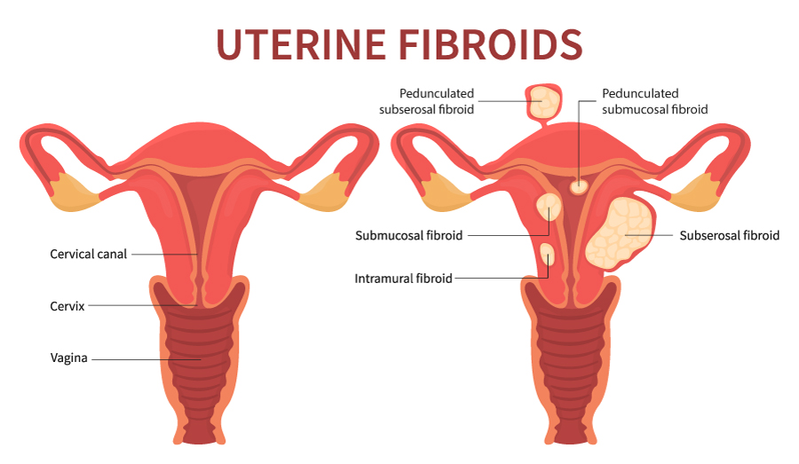 Uterine Fibroids diagramme