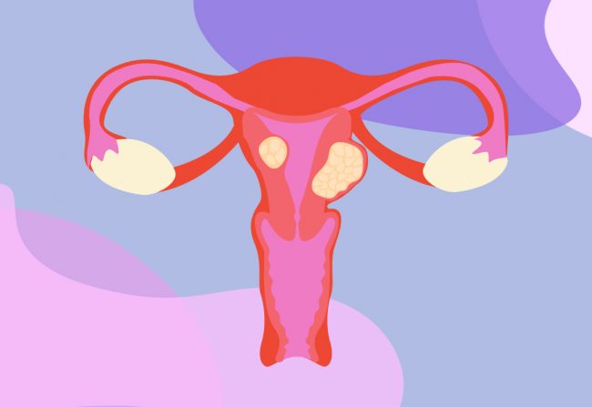 What are fibroids